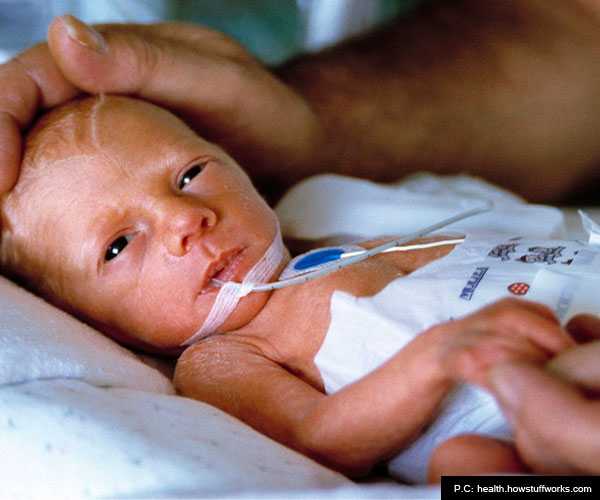 Long Term Effects of Prematurity